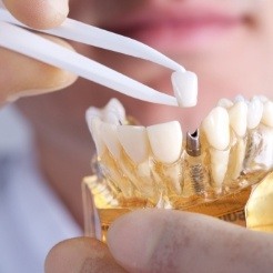 Model smile showing placement of dental restoration