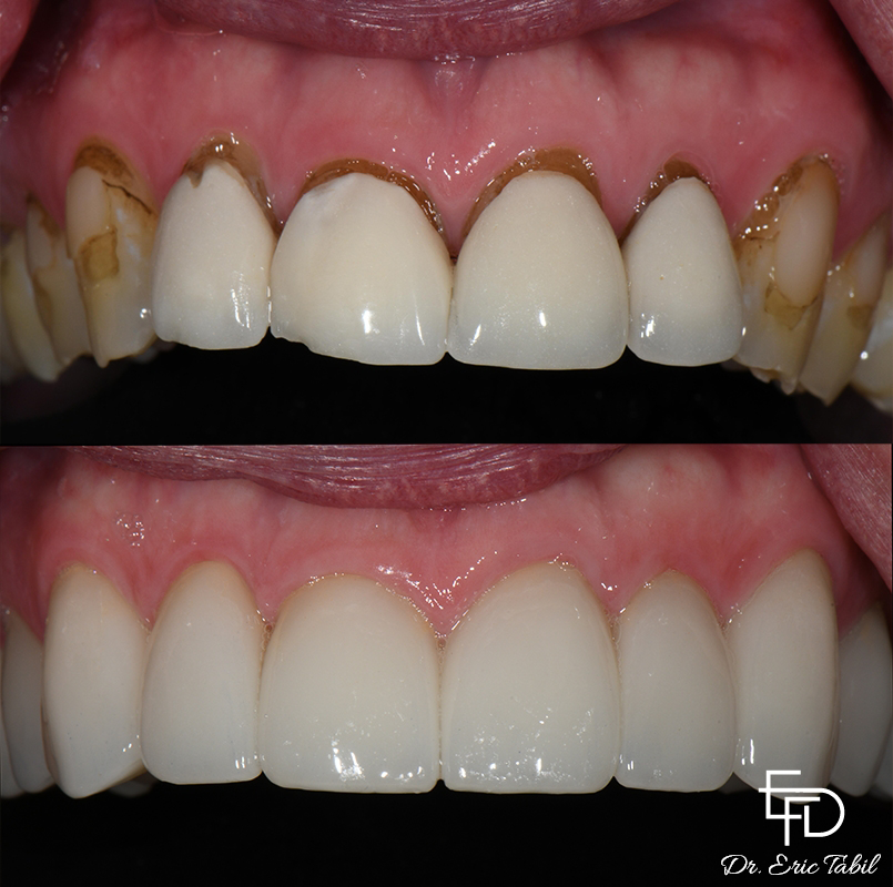 Smile before and after treating dark lines around base of teeth