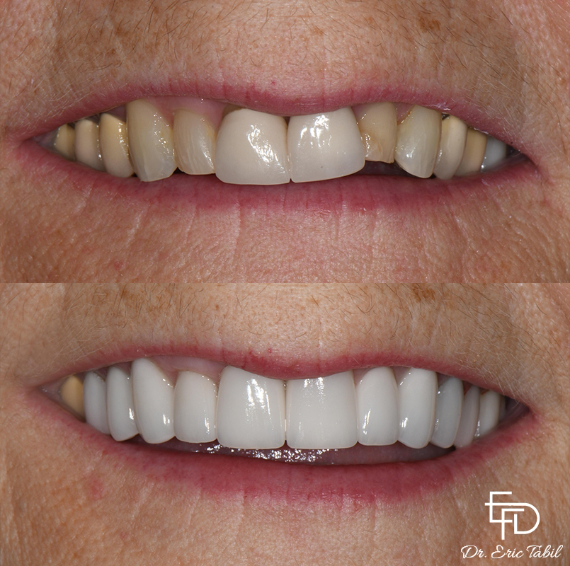 Smile before and after treating slightly misshapen teeth