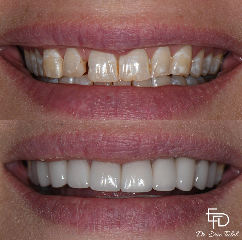 Smile before and after fixing flawed teeth