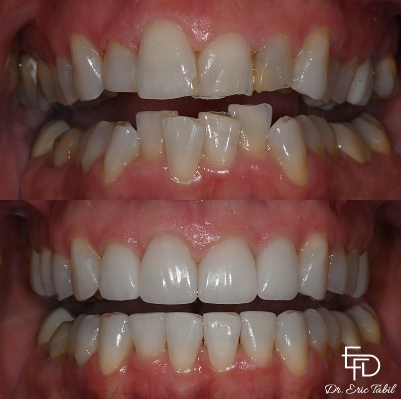 Close up of smile before and after Invisalign treatment