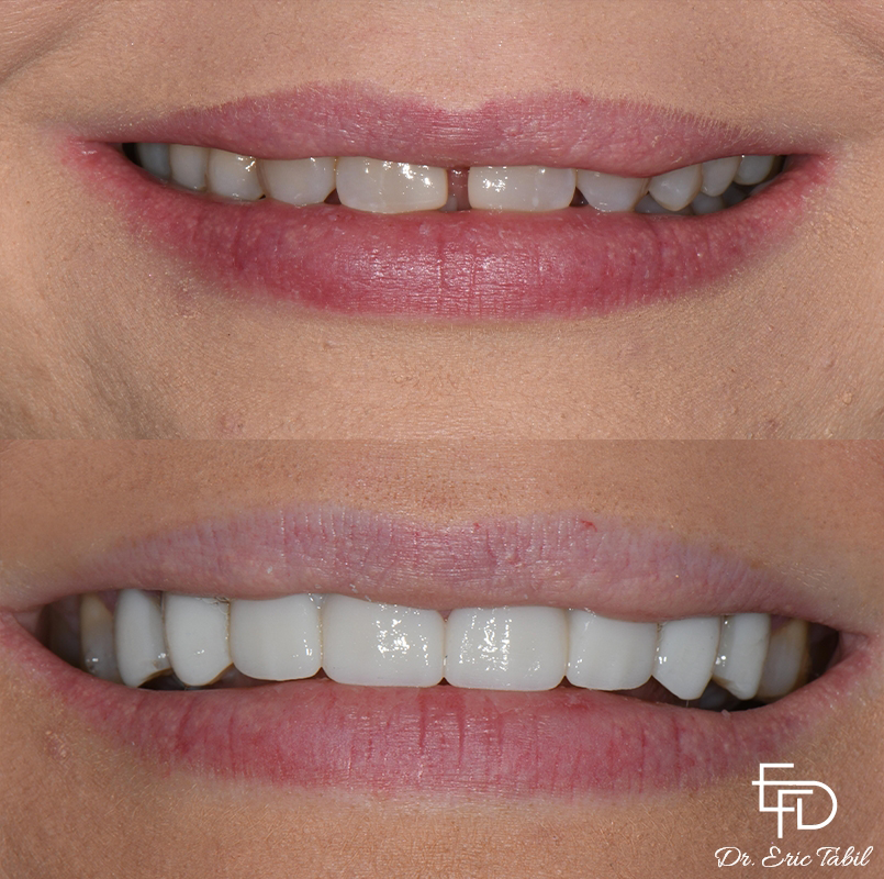 Smile before and after correcting a small gap between the two front teeth