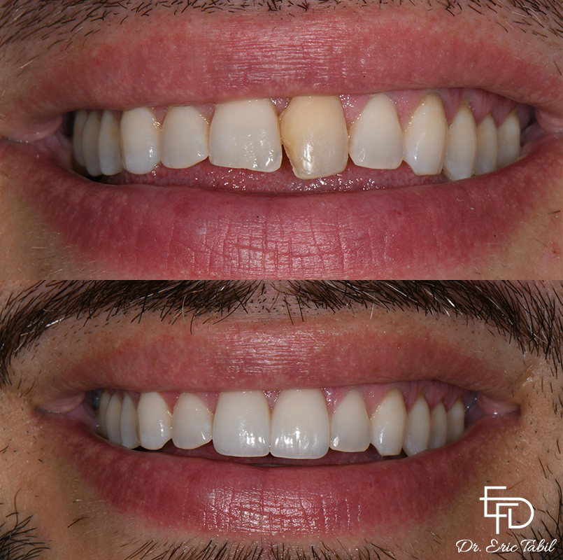 Smile before and after correcting stained teeth