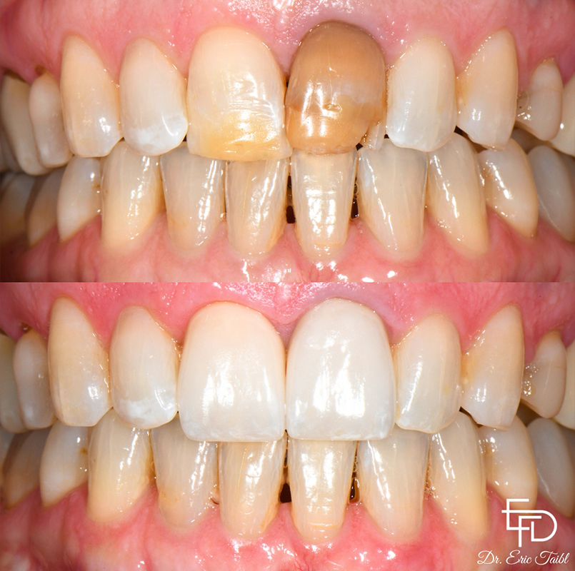 Smile before and after correcting flawed teeth