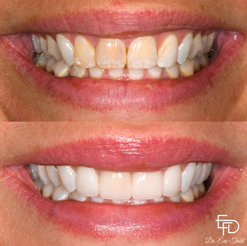 Smile before and after correcting flawed teeth