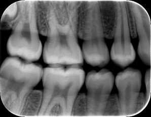 taking bitewing dental x rays