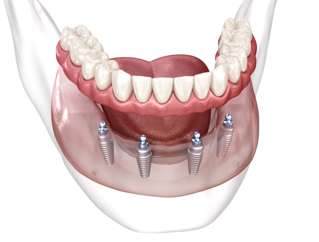 Illustration showing how dentures fit over All-On-4 implants with a white background